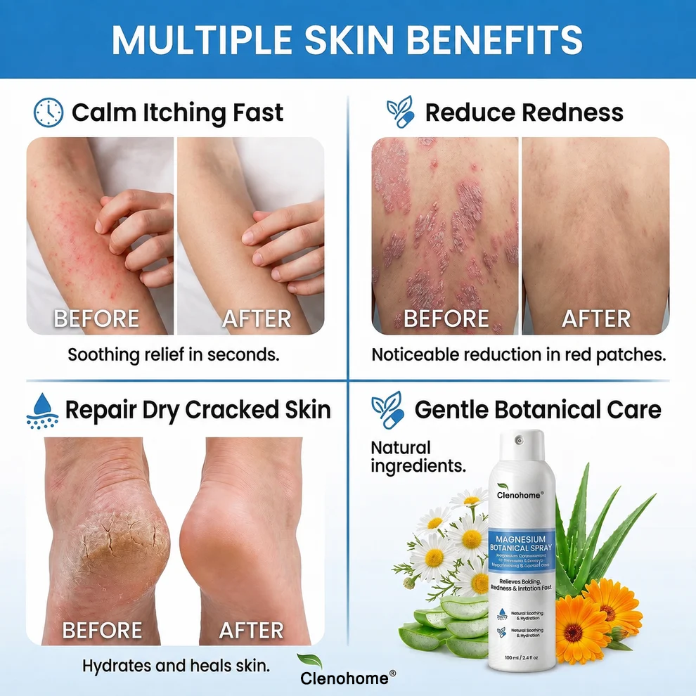 ✨Clenohome® Magnesium Botanical Spray – Advanced Skin Recovery for Psoriasis & Eczema | Rapid Soothing, Steroid-Free