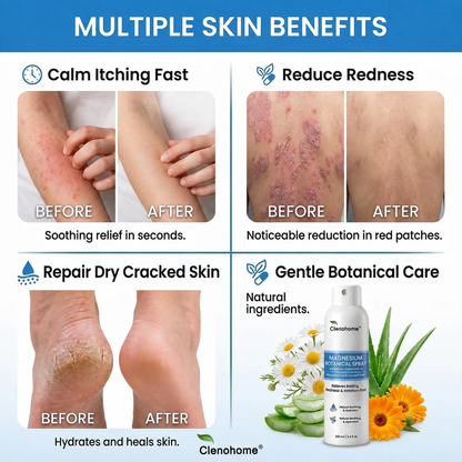 ✨Clenohome® Magnesium Botanical Spray – Advanced Skin Recovery for Psoriasis & Eczema | Rapid Soothing, Steroid-Free