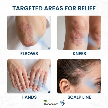 ✨Clenohome® Magnesium Botanical Spray – Advanced Skin Recovery for Psoriasis & Eczema | Rapid Soothing, Steroid-Free